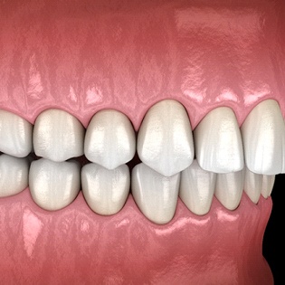 Image of an overbite
