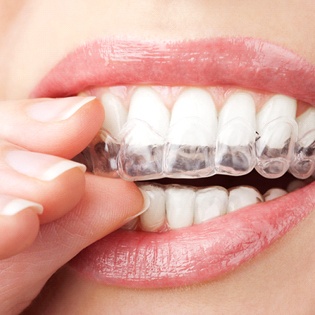 Woman putting in an Invisalign tray 