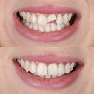Dental bonding is a durable, natural looking treatment that can repair broken teeth quickly and painlessly