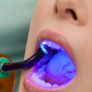 Dental bonding is great for patients with minor dental flaws and healthy teeth and gums
