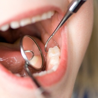 An up-close view of a dentist using specialized instruments to clean a person’s teeth in Tappan