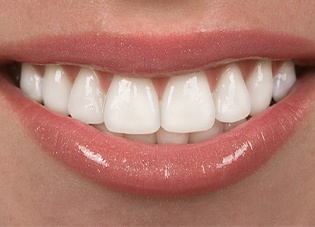 Veneer Tooth Color Chart