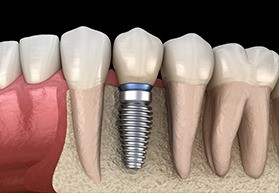 Animation of implant supported crown