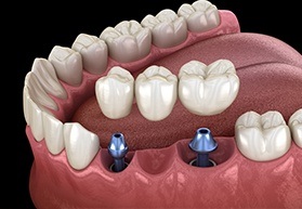 Animation of implant supported bridge