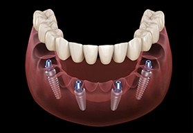 Animation of implant supported denture