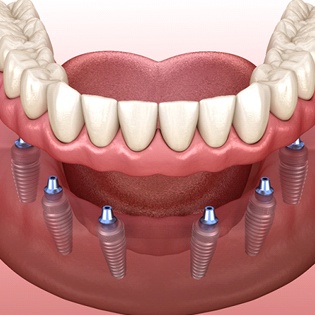 A digital image of six dental implants sitting beneath the gums and an implant-retained denture being placed on top of the posts