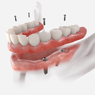 a digital illustration of implant dentures in Tappan