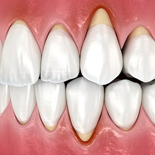 A CGI of a mouth with gum disease