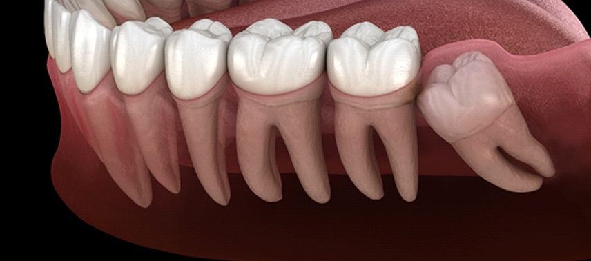 An impacted tooth in need of extraction