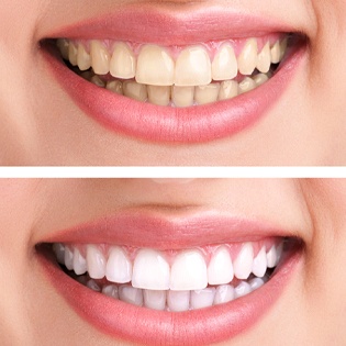 A before and after image of a person’s smile after teeth whitening