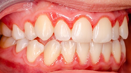 Patient undergoing a periodontal examination