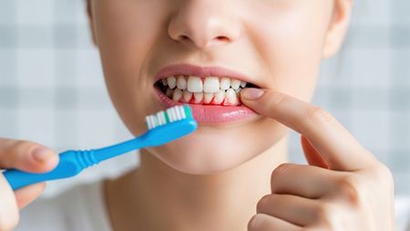 Gum pockets forming in digital image of gum disease
