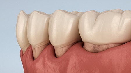 Gum pockets forming in digital image of gum disease