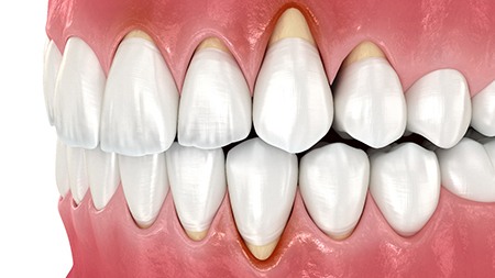 Digital image of gum recession