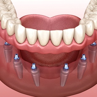 Implant-retained dentures