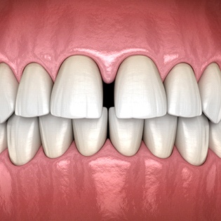 Digital image of a gap between the front teeth