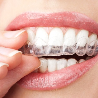 Woman putting in Invisalign aligner