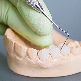 Model smile with fixed bridge restoration