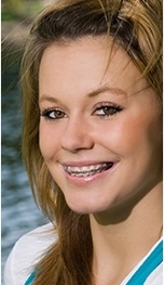 A female teenager shows off her traditional braces when smiling in Tappan