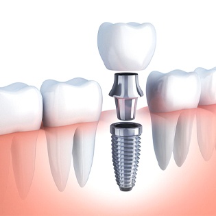 Single tooth implant