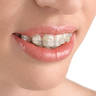 Smile with tooth-colored braces