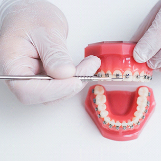 An orthodontist using a specialized dental tool on a mouth mold that has metal braces attached