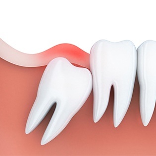 Animation of impacted wisdom tooth