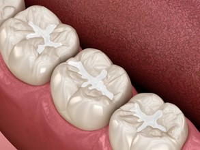 tooth-colored dental fillings