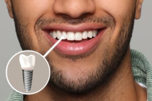 Man smiling with a front tooth dental implant