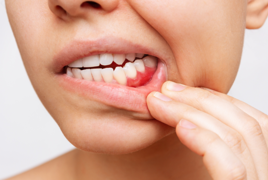 Woman pulling down lip to show inflamed gums